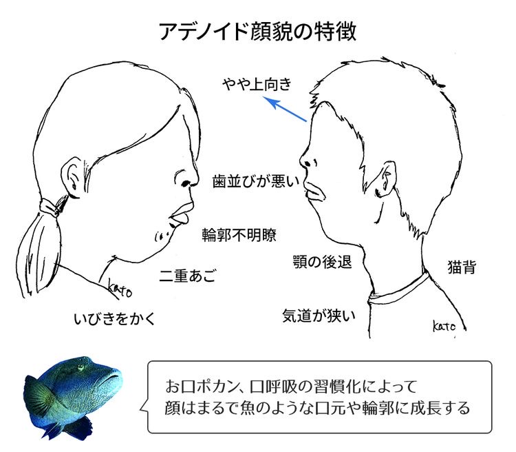 アデノイド 顔 と は